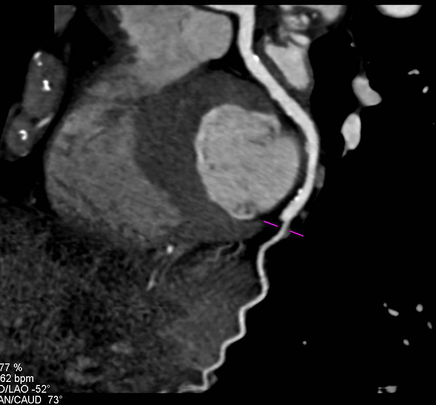 Coronary CTA with Minimal Plaque in the Coronary Arteries - CTisus CT Scan