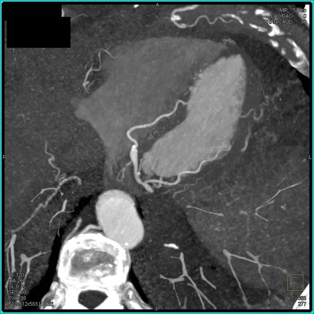 CCTA: Multivessel Disease without Significant Stenosis - CTisus CT Scan