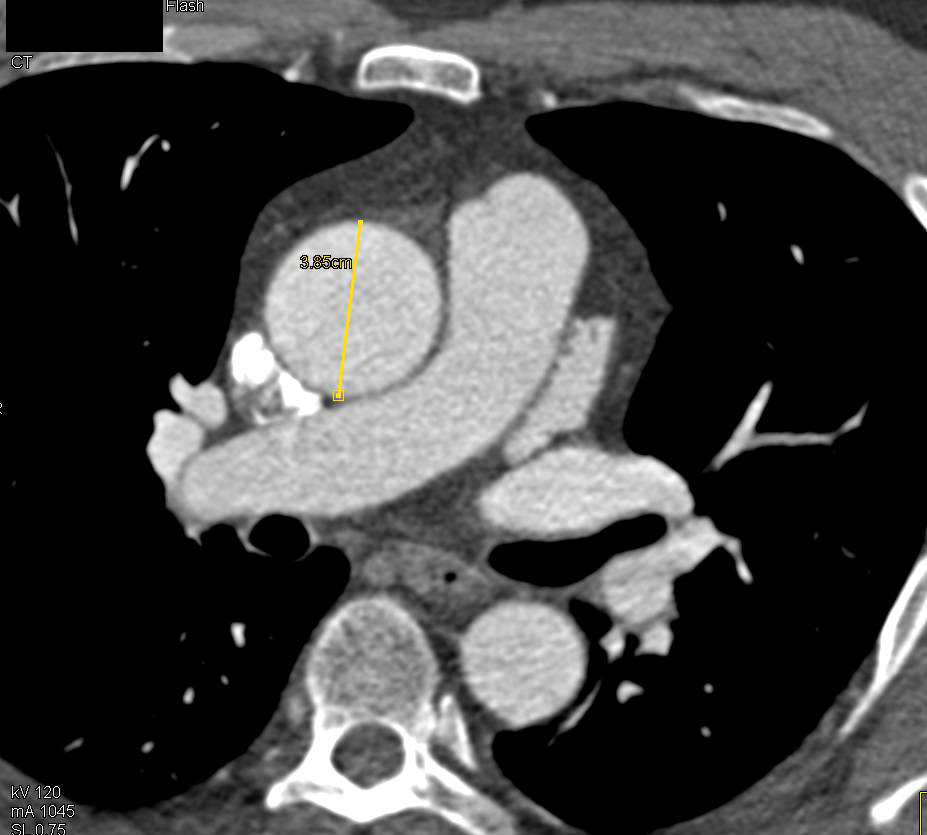 Dilated Aorta at Level of Sinus of Valsalva - CTisus CT Scan