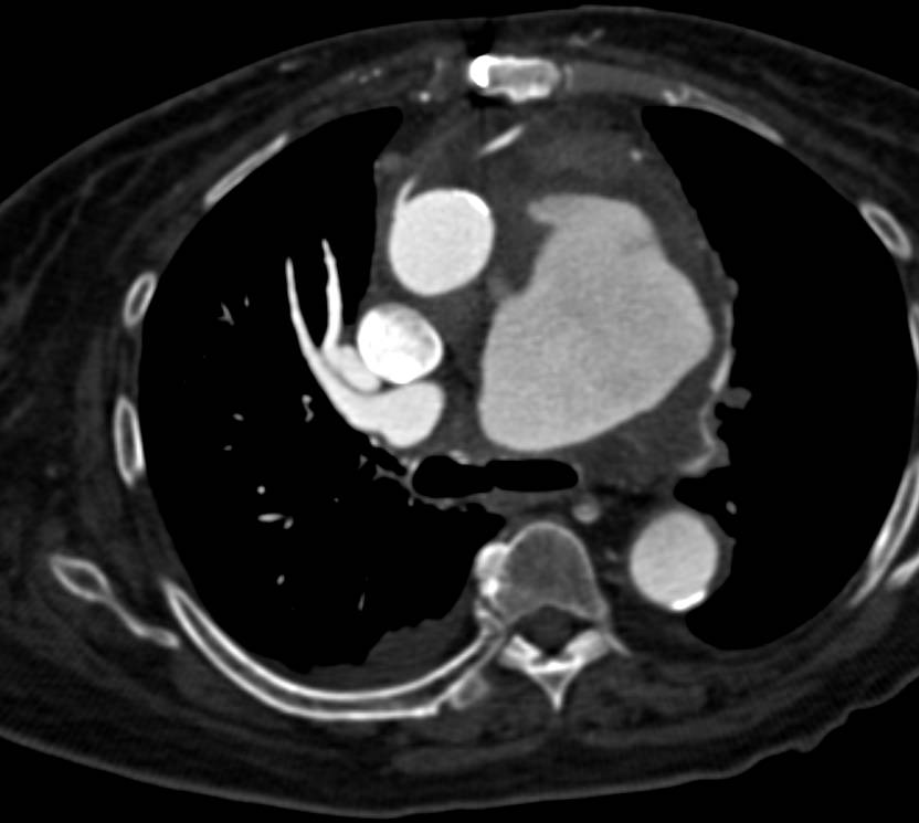 Large Ductus Aneurysm off the Aortic Arch - CTisus CT Scan