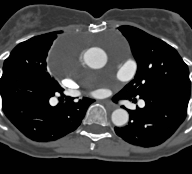 Fluid Around Aortic Root s/p Repair - CTisus CT Scan