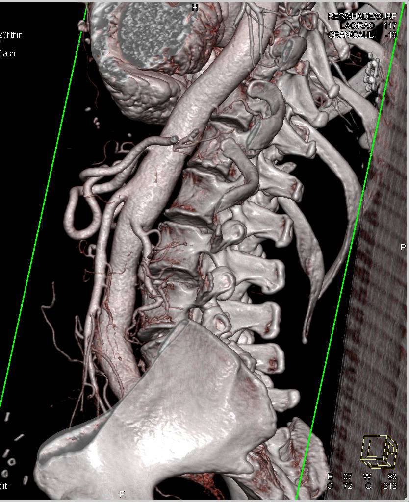 3D Mapping of Aortic Valve Replacement (AVR) and Coronary Artery Bypass in VRT - CTisus CT Scan