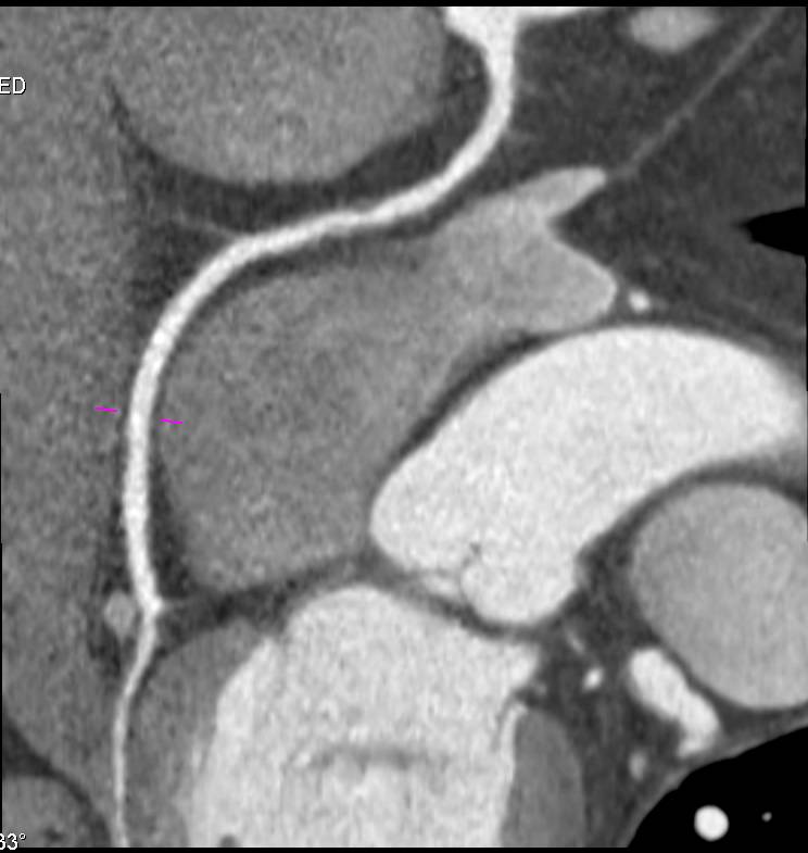 CCTA: Nice Example of Noncalcified Plaque - CTisus CT Scan