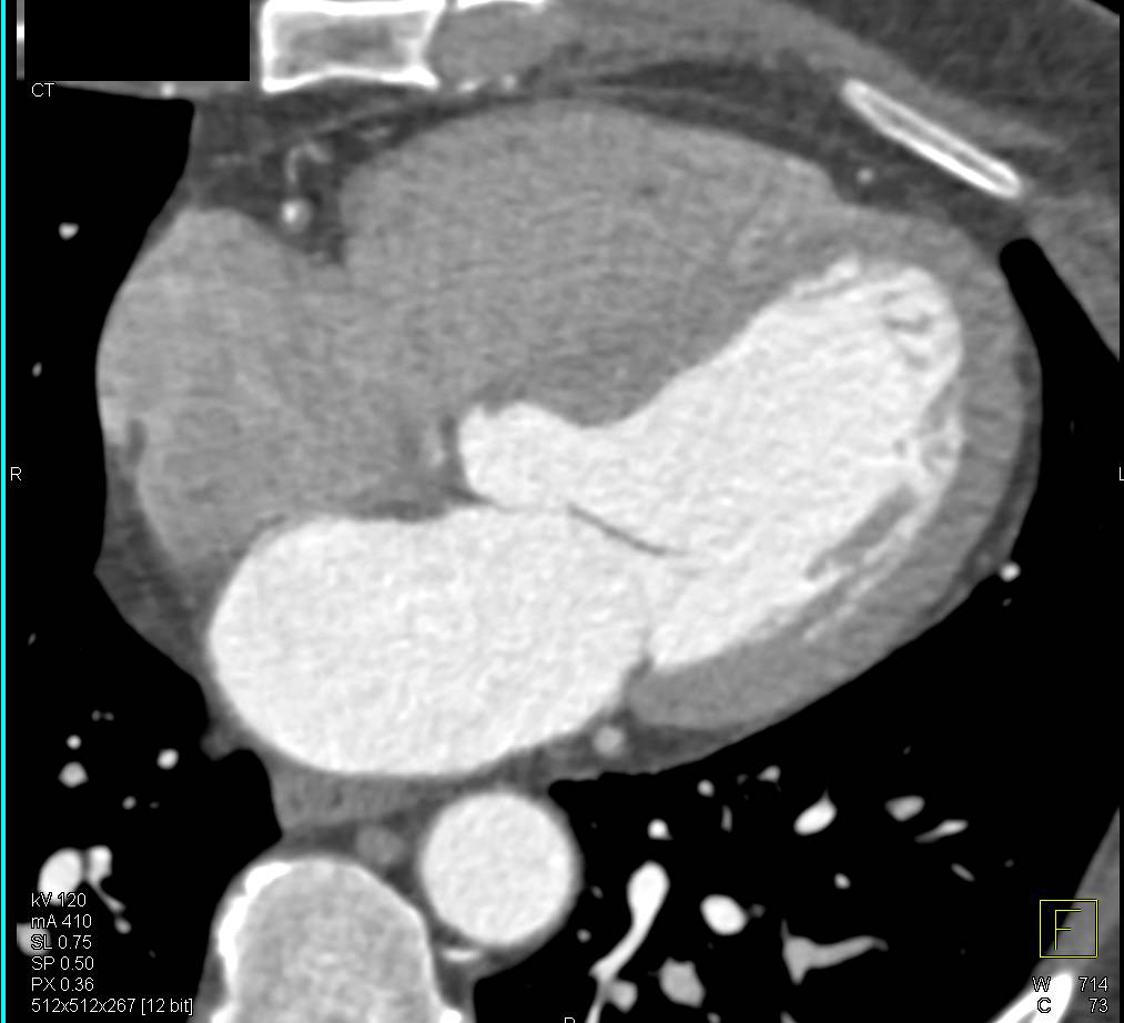 Coronary CTA with Evidence of Outpouching of Left Ventricle Represent Intracardiac Shunt - CTisus CT Scan