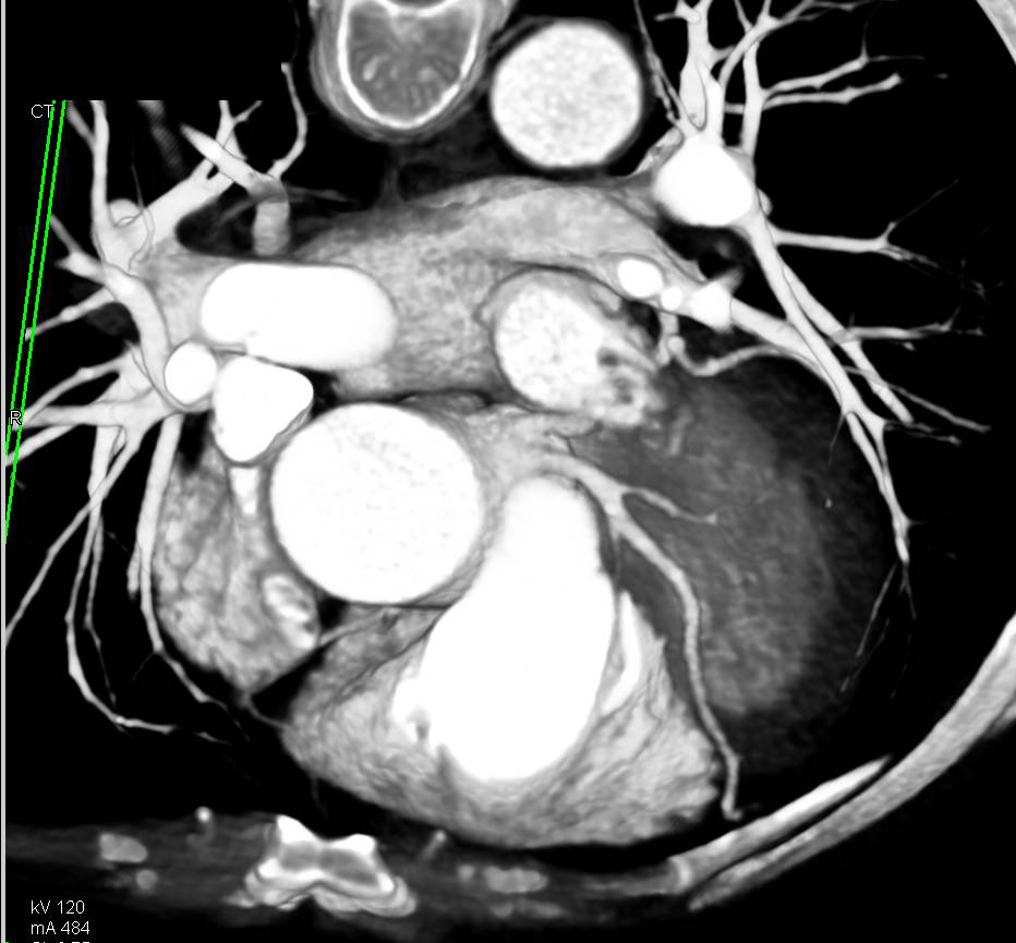 CCTA: Left Anterior Descending Artery (LAD) and Circumflex Arise Directly off the Left Cusp - CTisus CT Scan