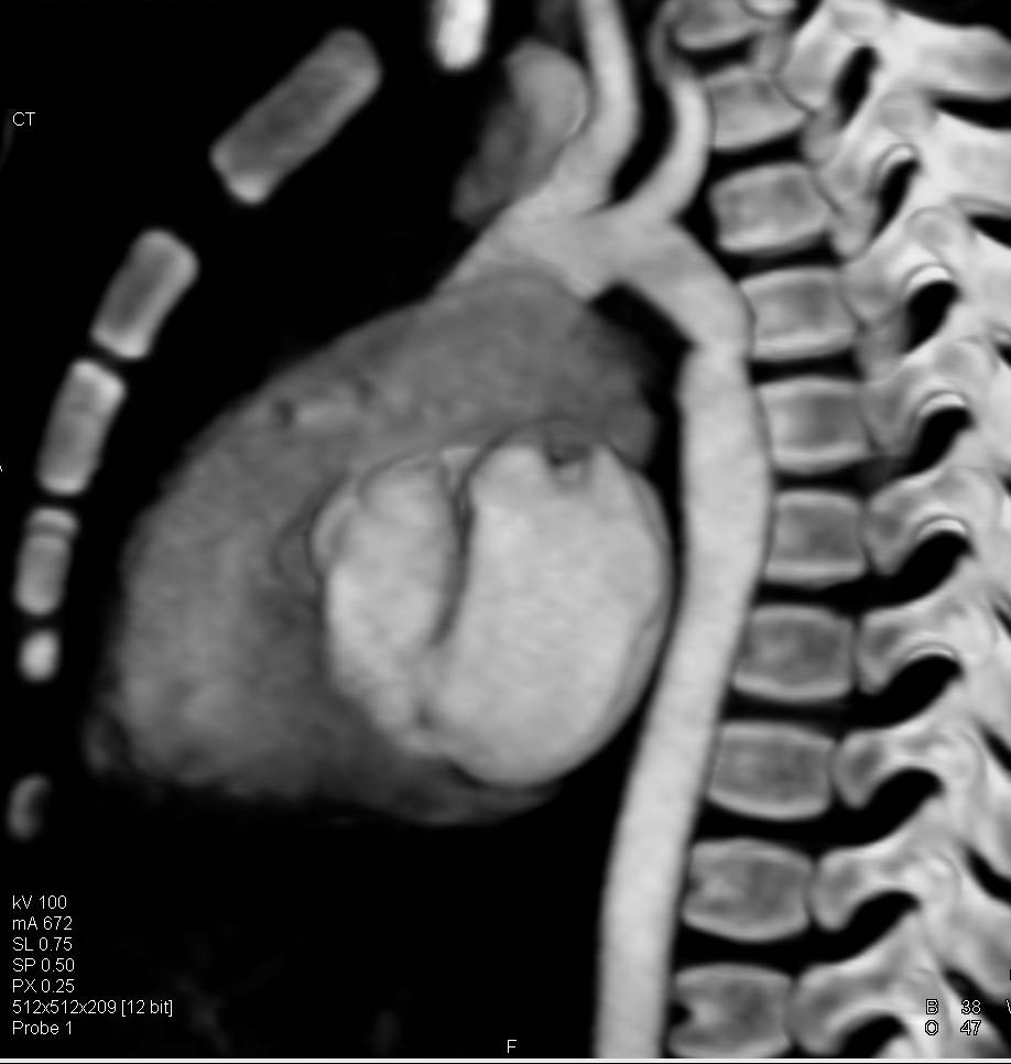 Prior Repair of a Coarctation of the Aorta - CTisus CT Scan