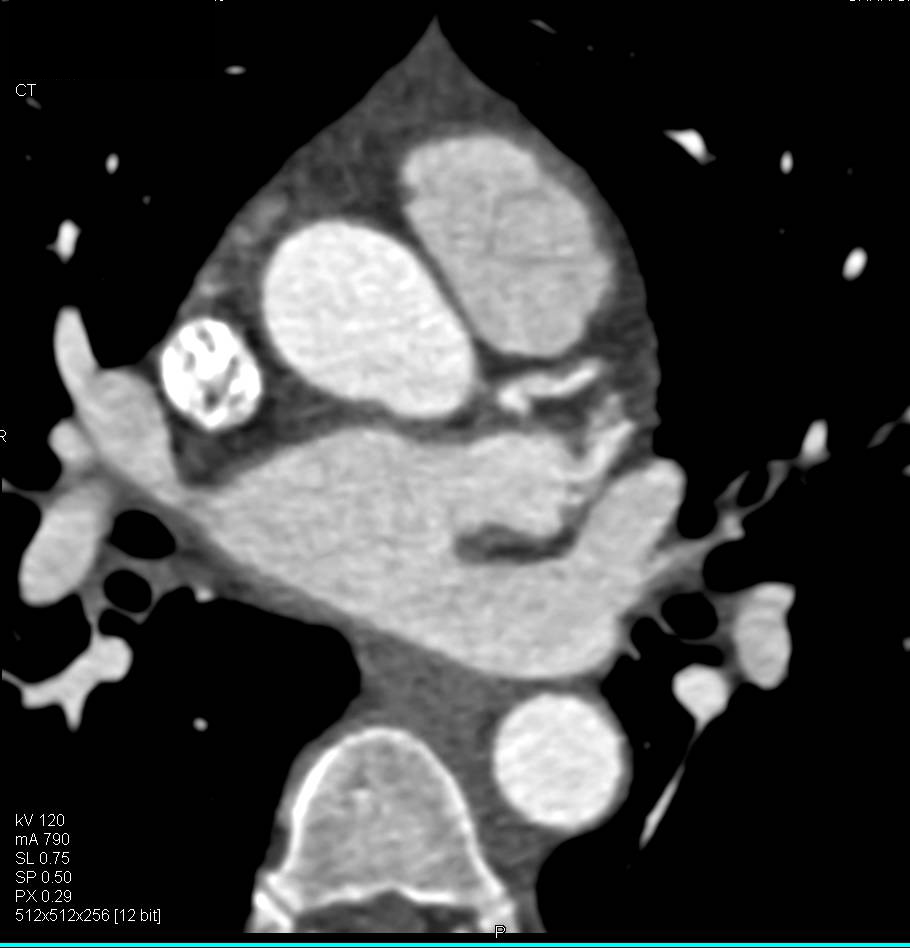 CCTA: Left Anterior Descending Coronary Artery (LAD) Plaque with around 50% Stenosis - CTisus CT Scan