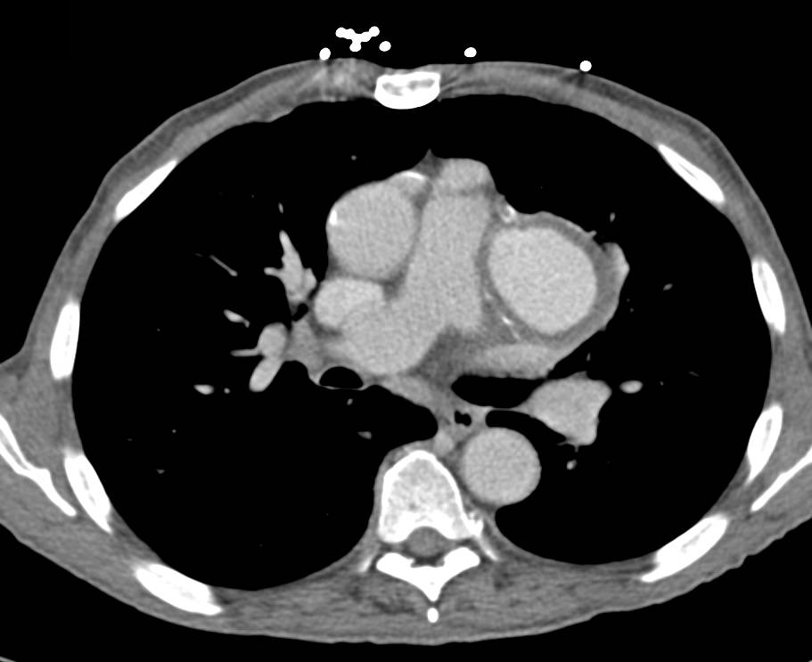 Circumflex Coronary Artery Aneurysm - CTisus CT Scan