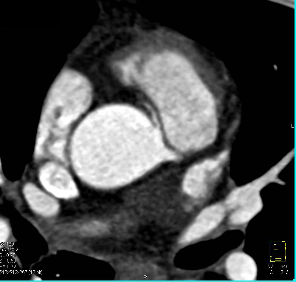 CCTA: Anomalous Origin of the Right Coronary Artery off the Left Cusp - CTisus CT Scan