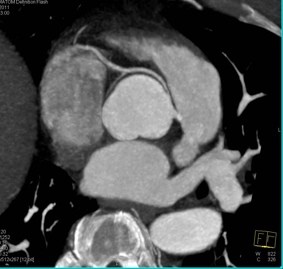 CCTA: Right Coronary Artery Arises off the Left Cusp in a Malignant Configuration - CTisus CT Scan