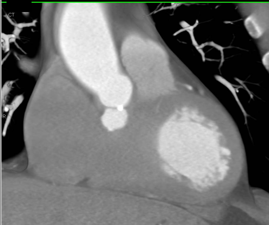 CCTA with Diseased Aortic Valve - CTisus CT Scan