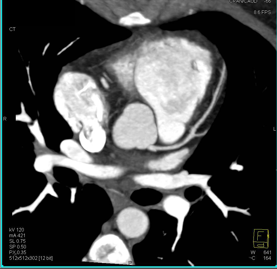 CCTA: Normal Left Anterior Descending Coronary Artery (LAD) without Stenosis - CTisus CT Scan