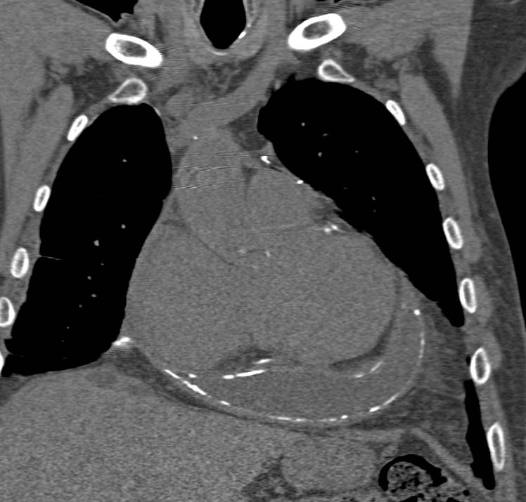 Extensive Pericardial Calcification - CTisus CT Scan