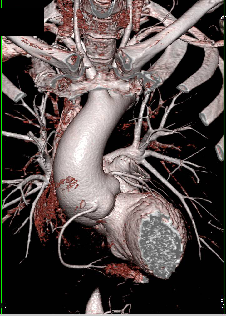 Dilated Aortic Root in Marfan Syndrome - CTisus CT Scan