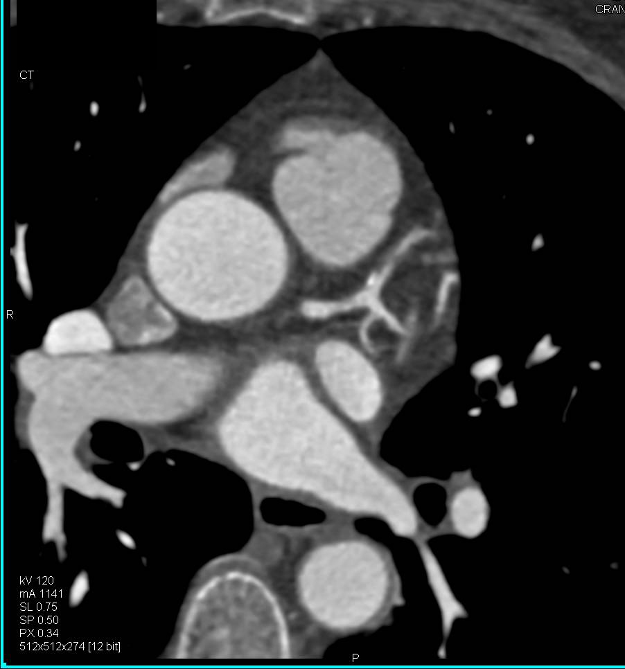 CCTA: Mixed Plaque in the Left Anterior Descending Coronary Artery (LAD) - CTisus CT Scan