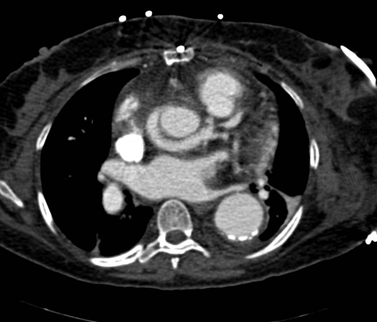 Aortic Root Repair with Reimplanted Coronary Arteries - CTisus CT Scan