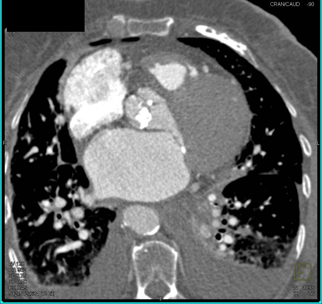 Preoperative Evaluation for Aortic Valve Replacement (AVR) Surgery. Note the Extensive Aortic Valve Calcifications - CTisus CT Scan