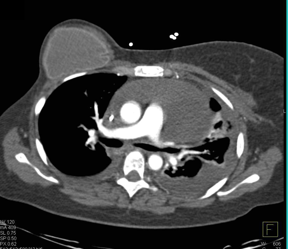 Large Pericardial Effusion Causes Cardiac Tamponade - CTisus CT Scan