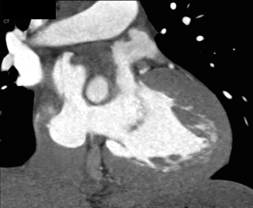 Atrial Septal Defect (ASD) in 3D - CTisus CT Scan