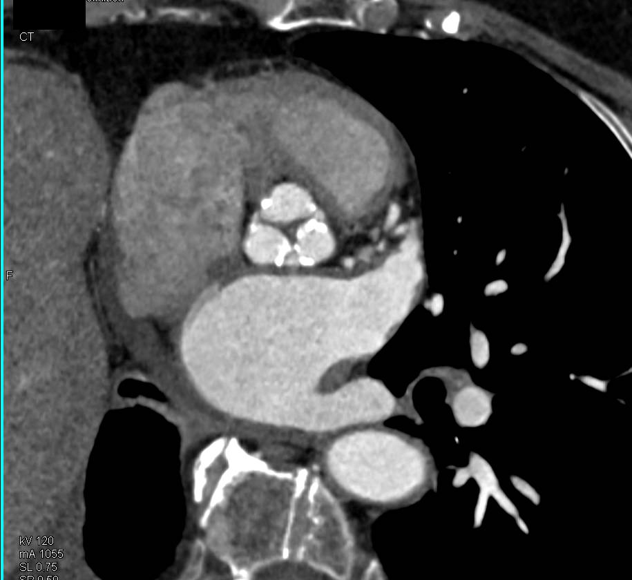 Calcified Aortic Valve with Aortic Stenosis - CTisus CT Scan