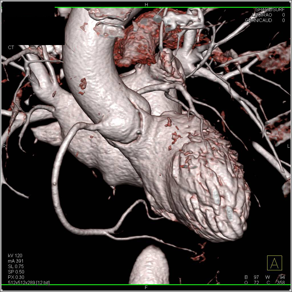 CCTA: Normal Right Coronary Artery - CTisus CT Scan