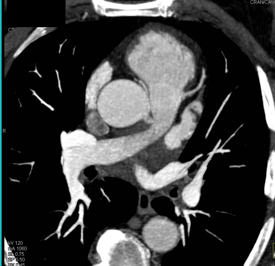 Anomalous Origin of the Right Coronary Artery off the Left Cusp - CTisus CT Scan