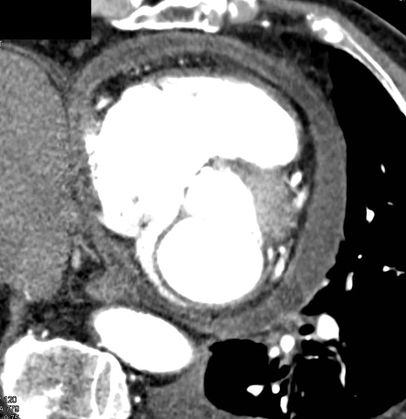 Pericardial Thickening and Aortic Aneurysm - CTisus CT Scan