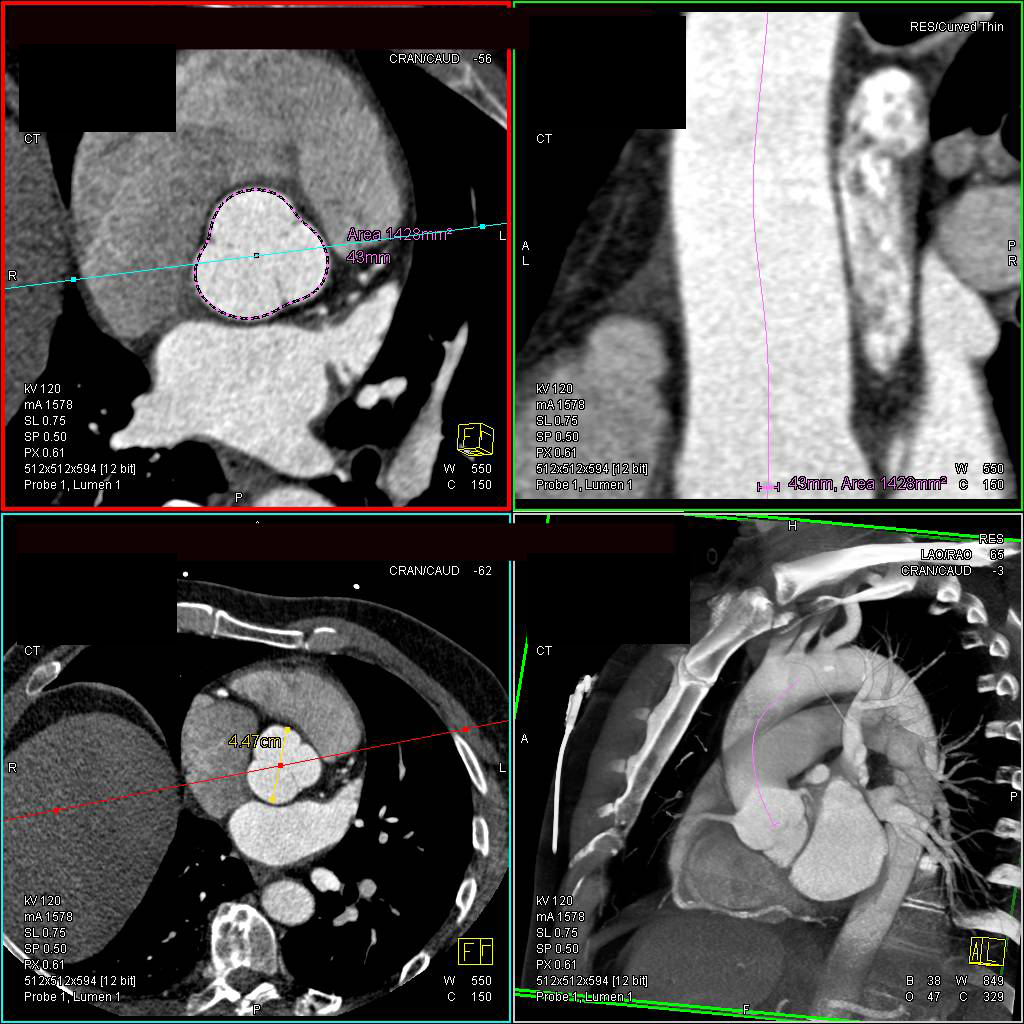 Center Line Measurement of Ascending Aorta - CTisus CT Scan