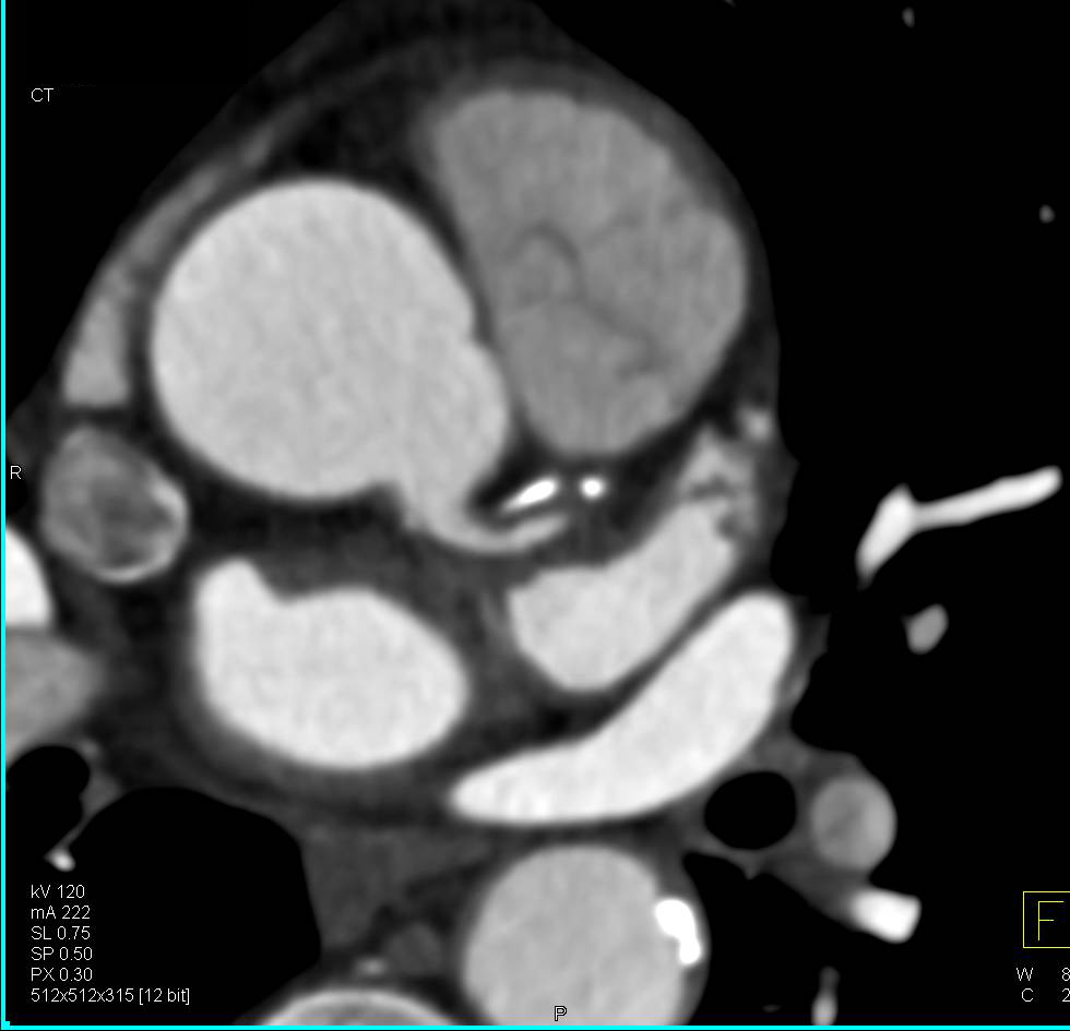 CCTA with Critical Left Anterior Descending Coronary Artery (LAD) Stenosis Greater Than 70% - CTisus CT Scan