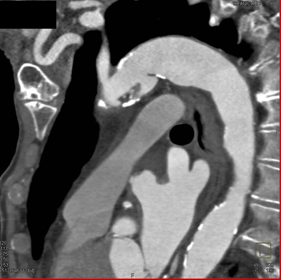 Focal Aortic Dissection - CTisus CT Scan