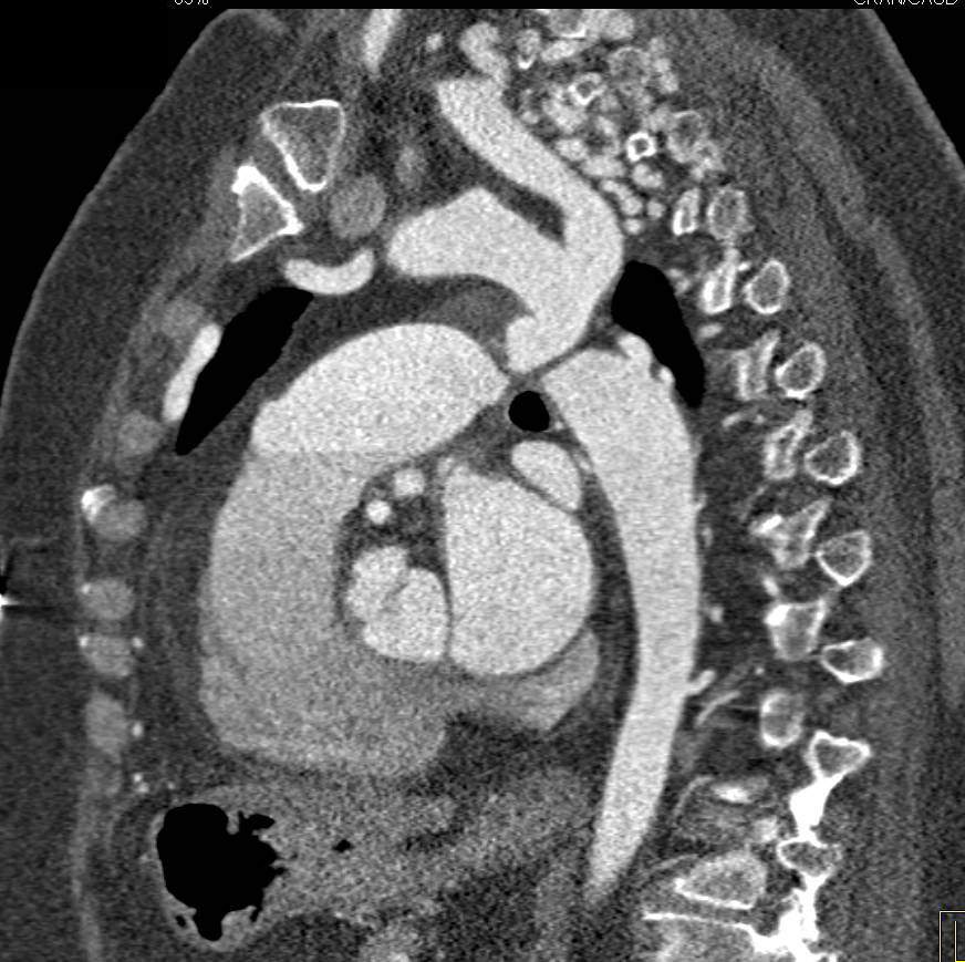 Coarctation Of The Aorta With Impressive Collaterals Cardiac Case