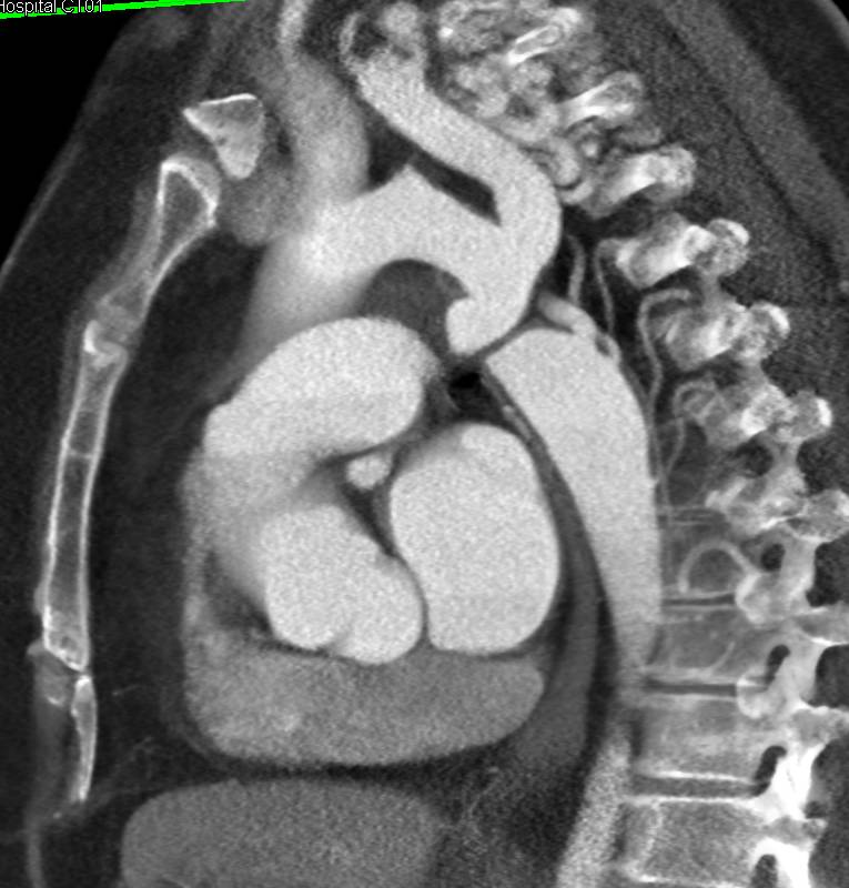 Dilated Internal Mammary Arteries in a Patient with Coarctation of the Aorta - CTisus CT Scan