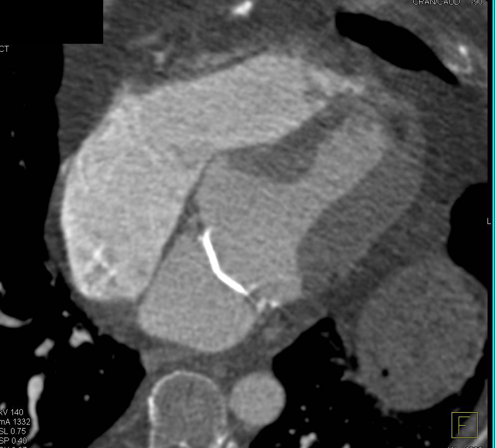 Aortic Valve Replacement in Normal Position - CTisus CT Scan