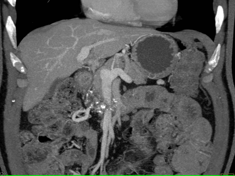 Stenosis Right Pulmonary Vein - CTisus CT Scan