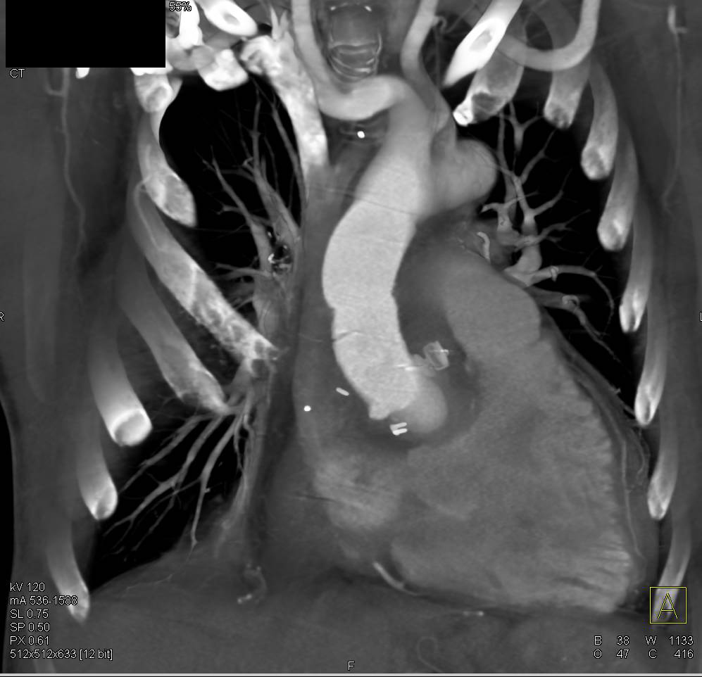 Postoperative Repair of an Aortic Root Pseudoaneurysms - CTisus CT Scan