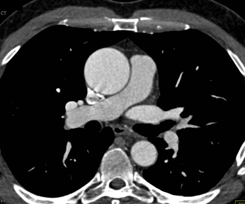 Dilated Ascending Aorta due to Aortic Stenosis - CTisus CT Scan