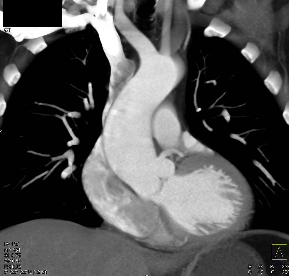 Aortic Stenosis with Calcifications Aortic Valve - CTisus CT Scan