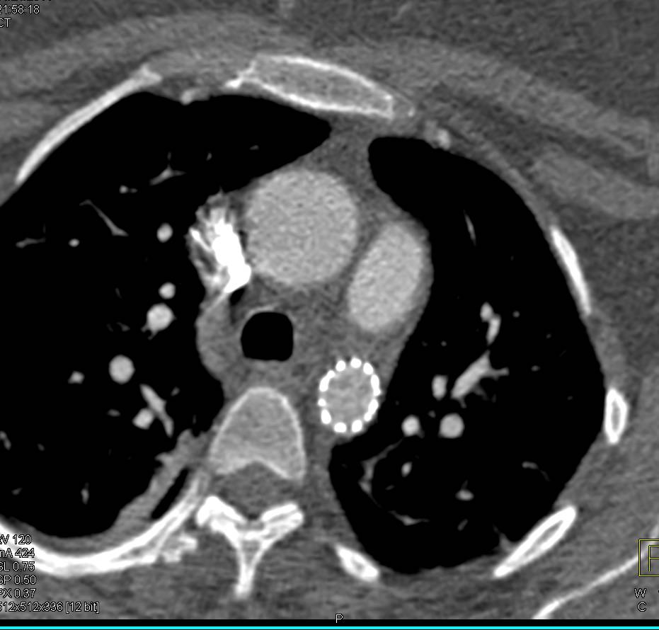 Coarctation of the Aorta with Stent Repair - CTisus CT Scan