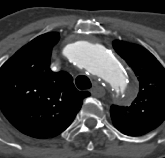 Endovascular Stent in Thoracic Aorta with Reimplantation of the Subclavian Artery - CTisus CT Scan