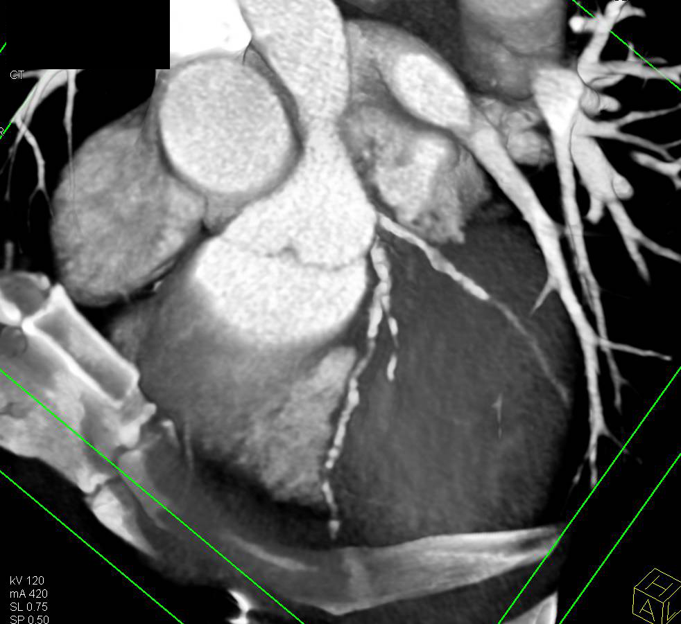 CCTA: Diseased Left Anterior Descending Coronary Artery (LAD) with Calcified and Noncalcified Plaque with Stenosis - CTisus CT Scan