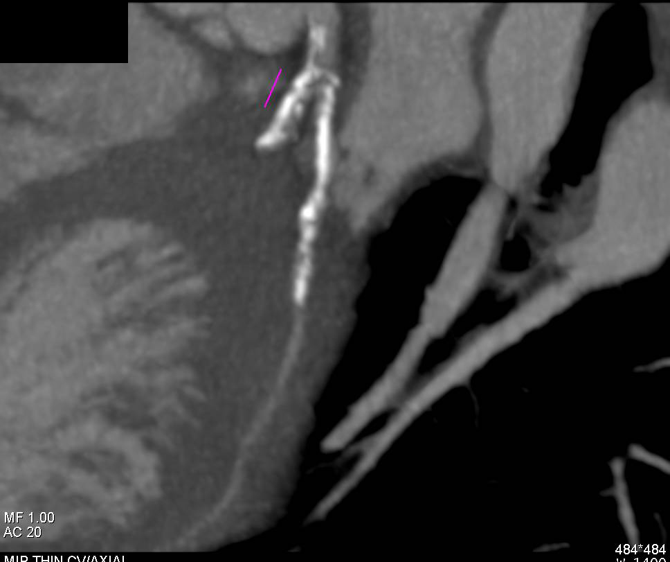 CCTA: Critical Left Anterior Descending Coronary Artery (LAD) Stenosis - CTisus CT Scan