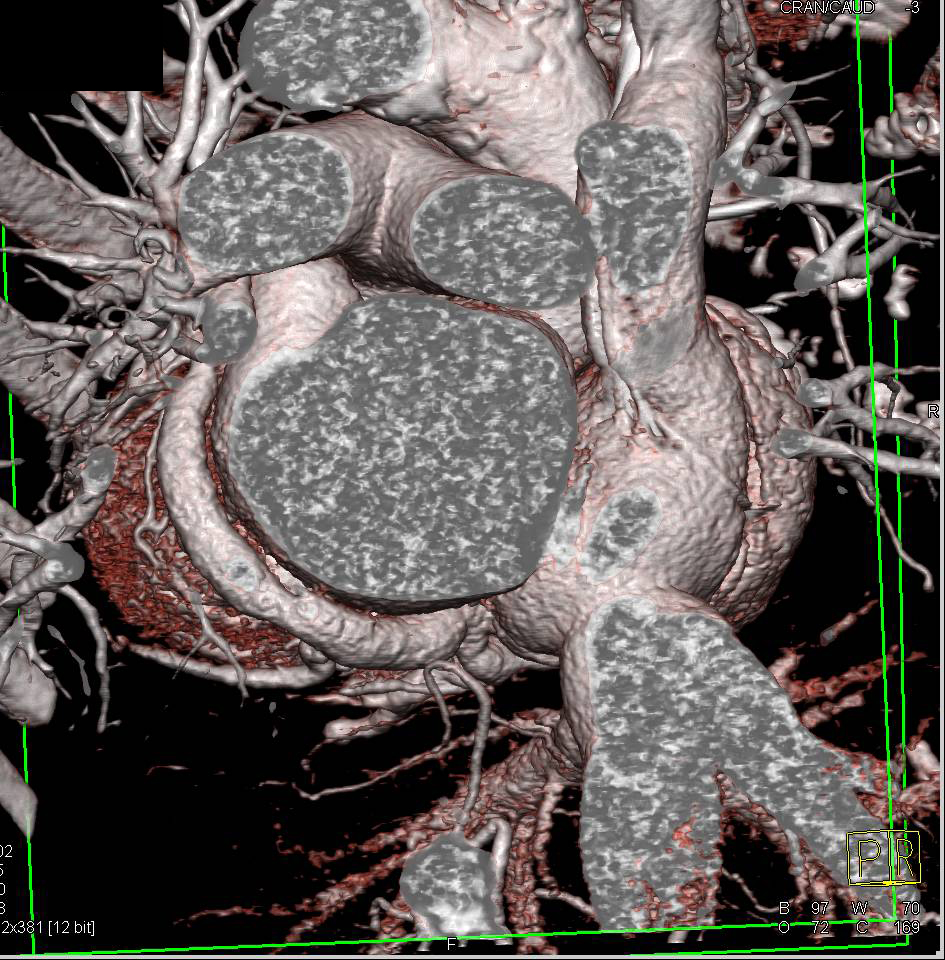 Aortic Valve Calcifications with Aortic Stenosis and Pre-Operative Planning - CTisus CT Scan