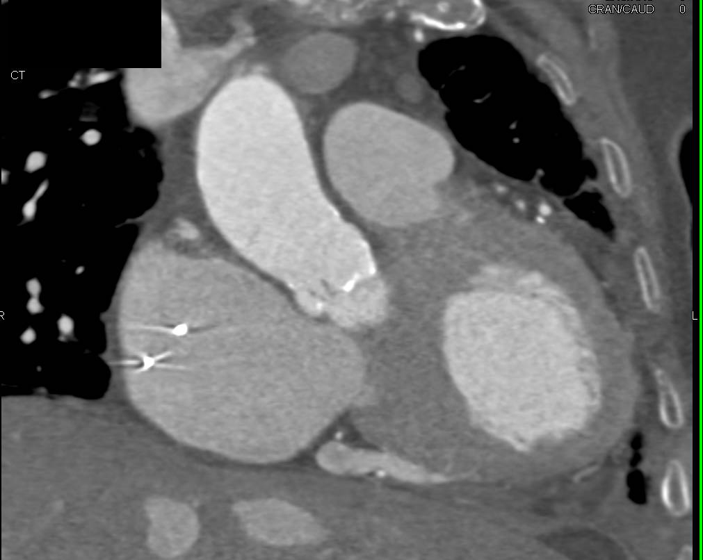 Aortic Valve Disease and Coronary Disease - CTisus CT Scan