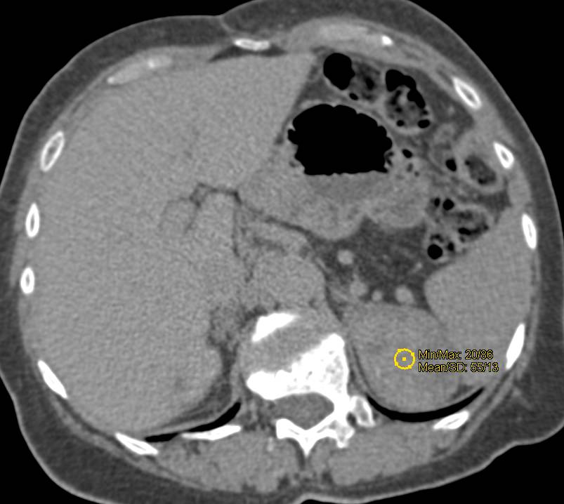 Adrenal Myelolipoma with Fat and Calcification Seen as Incidental Finding on Cardiac CTA - CTisus CT Scan