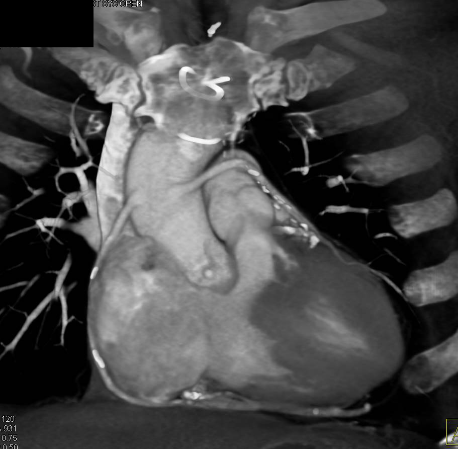 CCTA: Patent Coronary Artery Bypass Graft with Severe Aortic Valve Stenosis - CTisus CT Scan