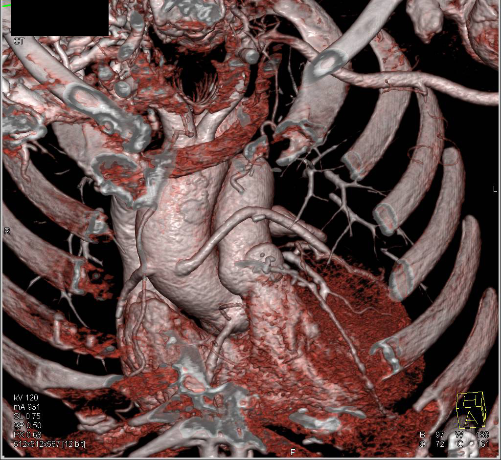 3D Mapping of Coronary Artery Bypass Grafts - CTisus CT Scan