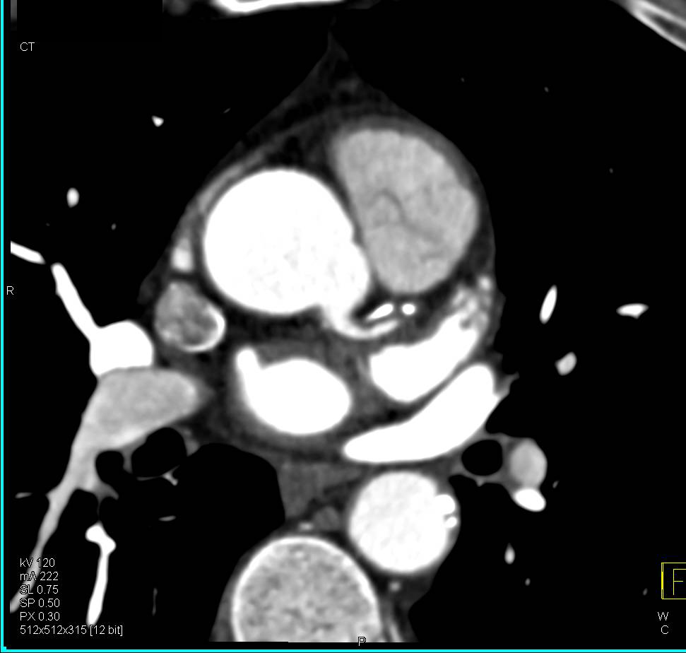 CCTA: Left Anterior Descending Coronary Artery (LAD) Plaque with Greater Than 50% Stenosis - CTisus CT Scan