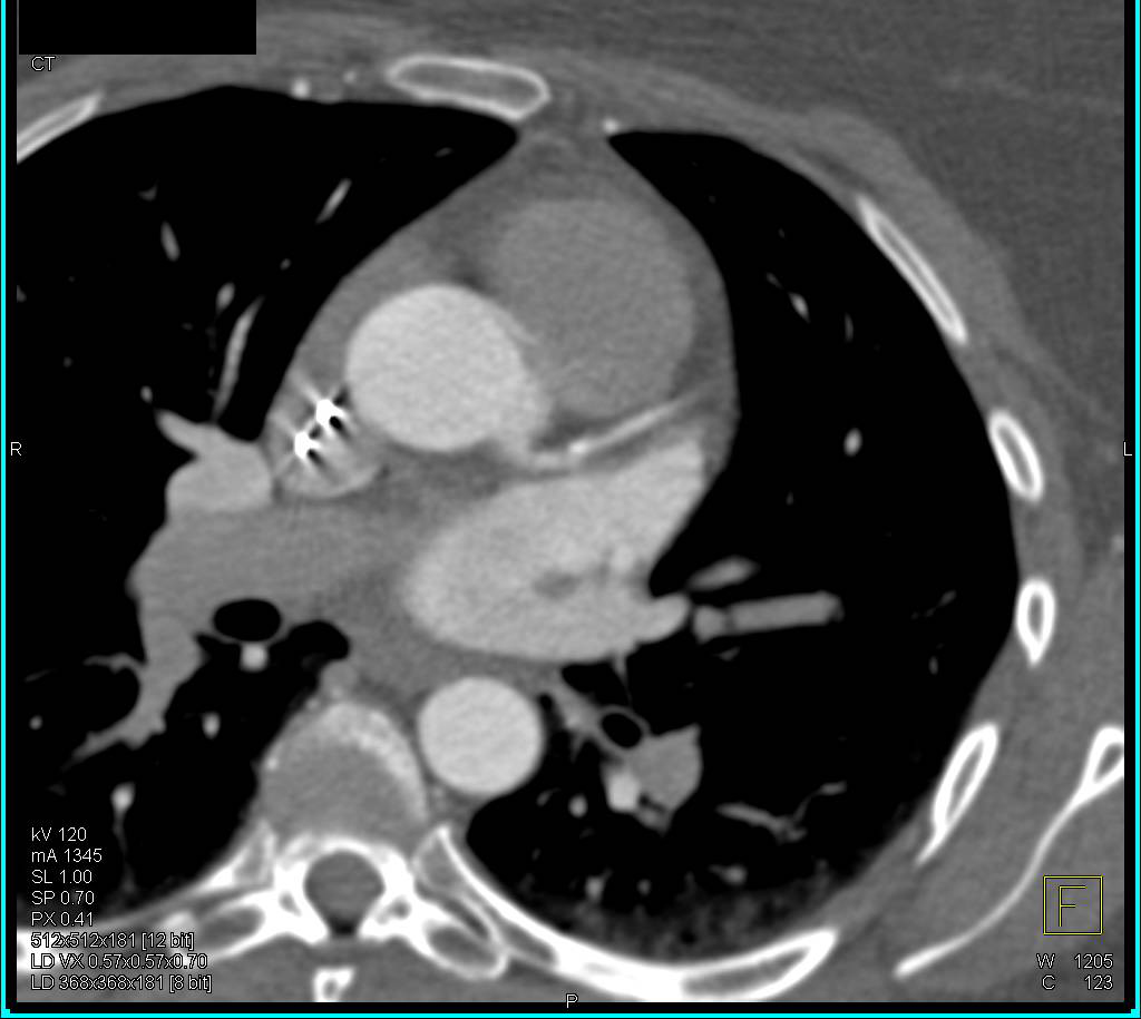 CCTA: Left Anterior Descending Coronary Artery (LAD) with Minimal Plaque - CTisus CT Scan