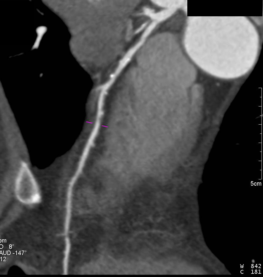 CCTA: Mixed Plaque Left Anterior Descending Coronary Artery (LAD) - CTisus CT Scan