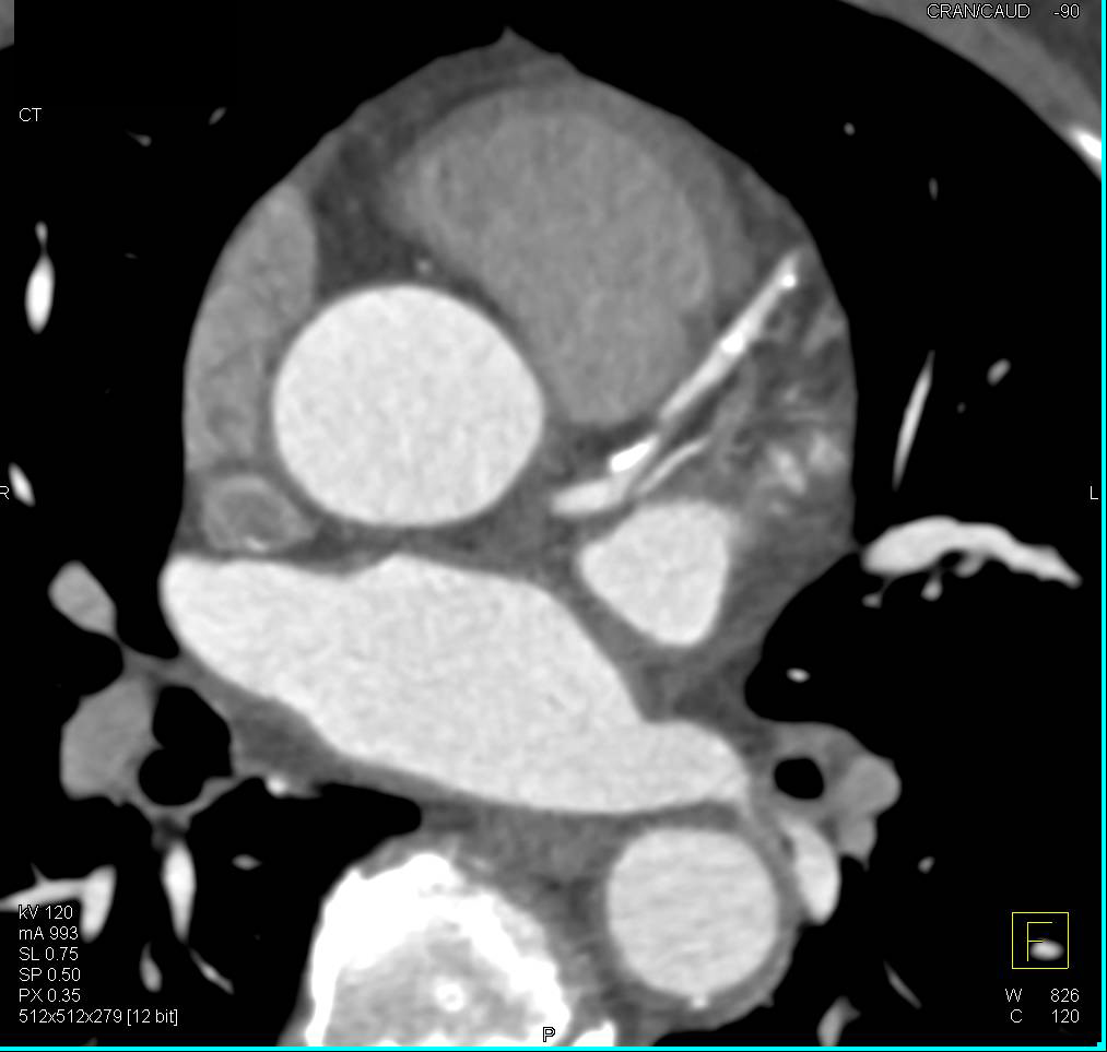 CCTA: Mixed Plaque Left Anterior Descending Coronary Artery (LAD) with Stenosis - CTisus CT Scan